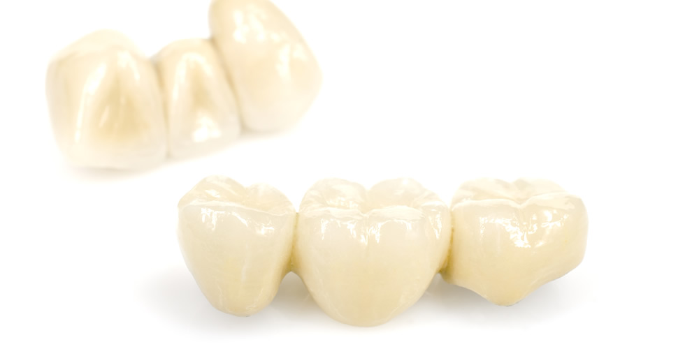 歯の治療に使われる詰め物とかぶせ物の種類