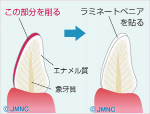 セラミック