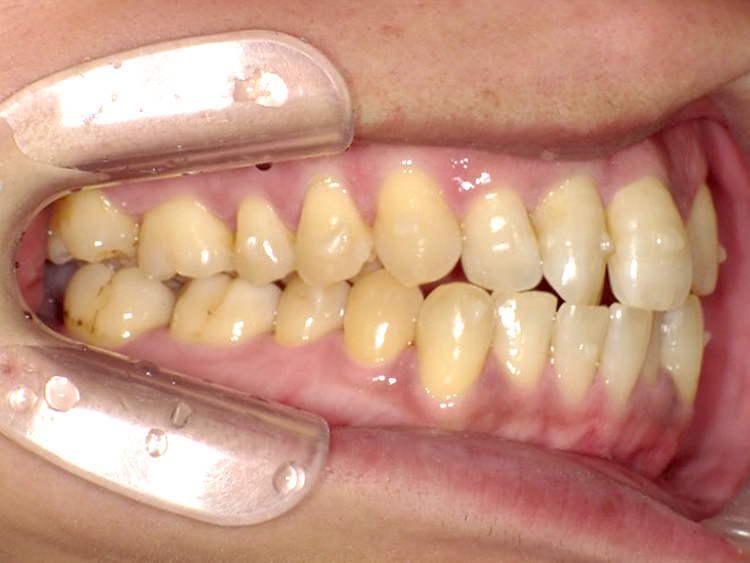 インビザラインの症例