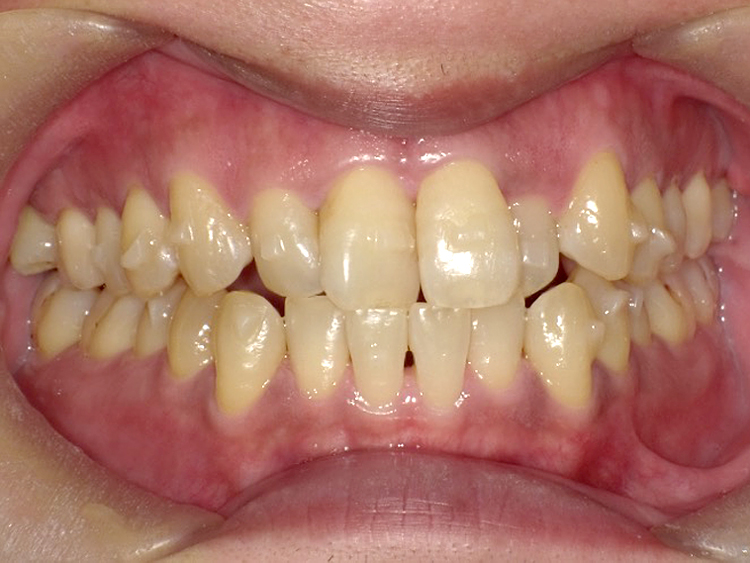 インビザラインの症例