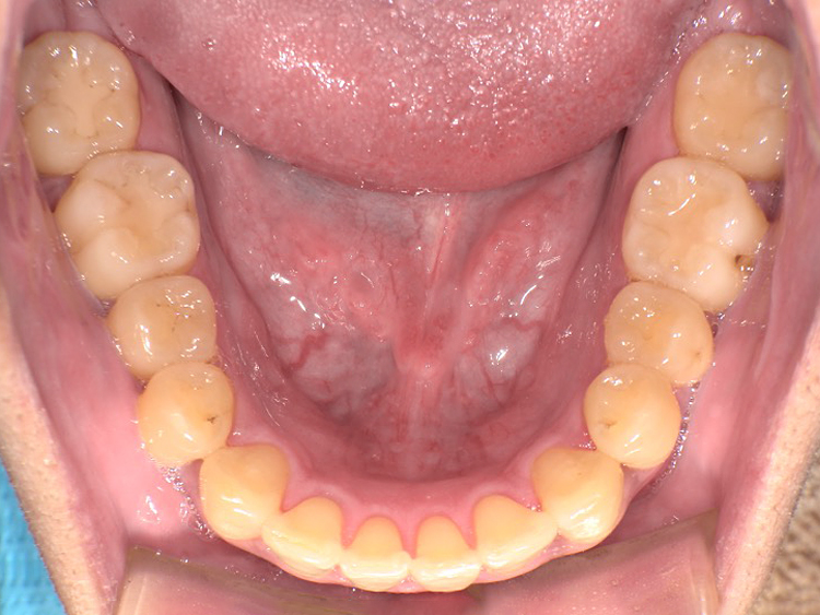 インビザラインの症例