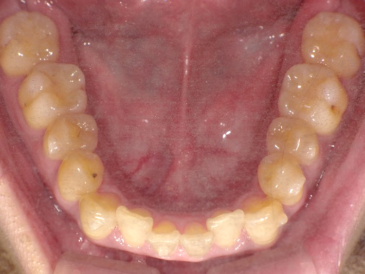 インビザラインの症例