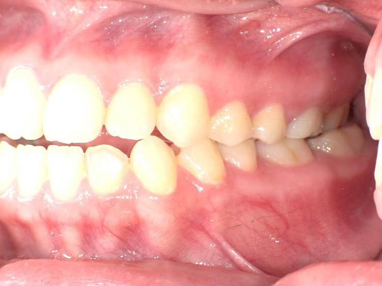 インビザラインの症例