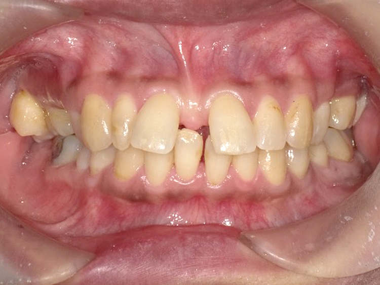 インビザラインの症例