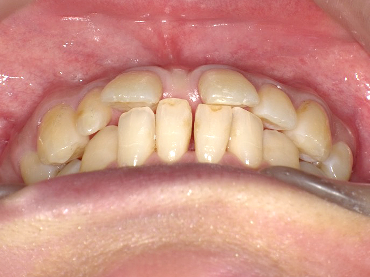 インビザラインの症例