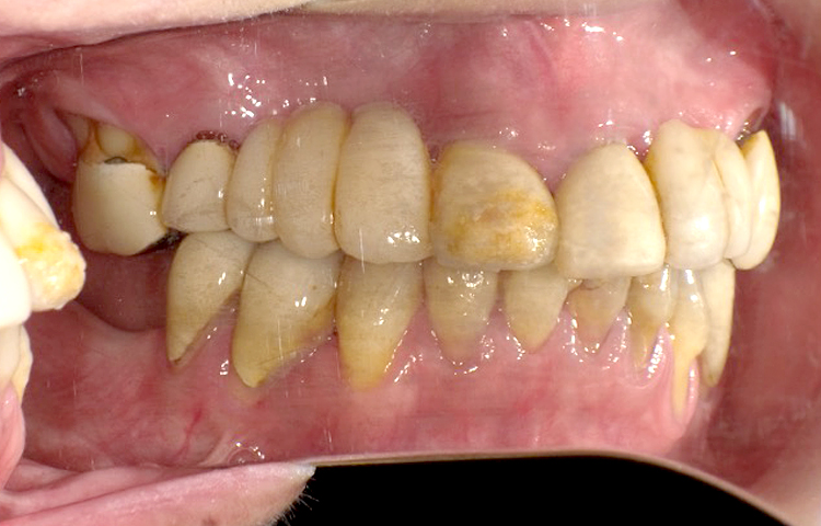 審美歯科の症例