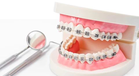 マウスピース矯正