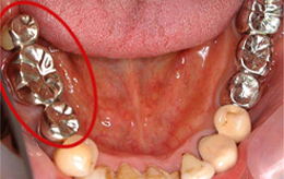 右奥に銀歯のブリッジが入っている口腔内の写真