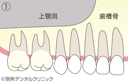 サイナスリフトの流れ