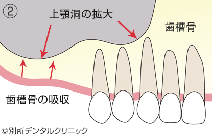 サイナスリフトの流れ