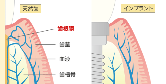 インプラント周囲炎