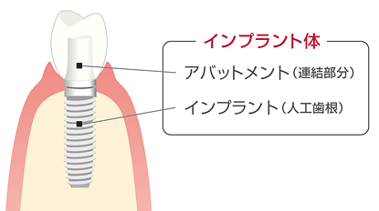 当院のインプラント保証