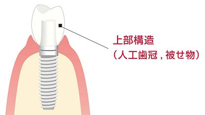 当院のインプラント保証