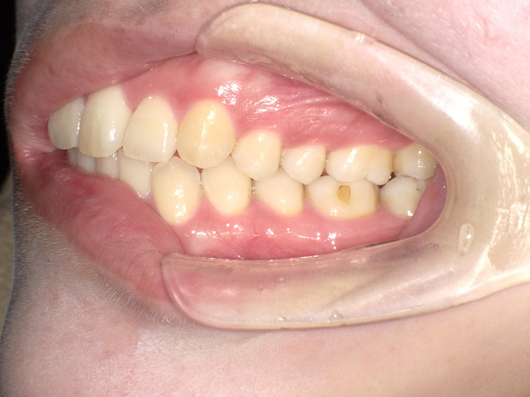 部分矯正の症例