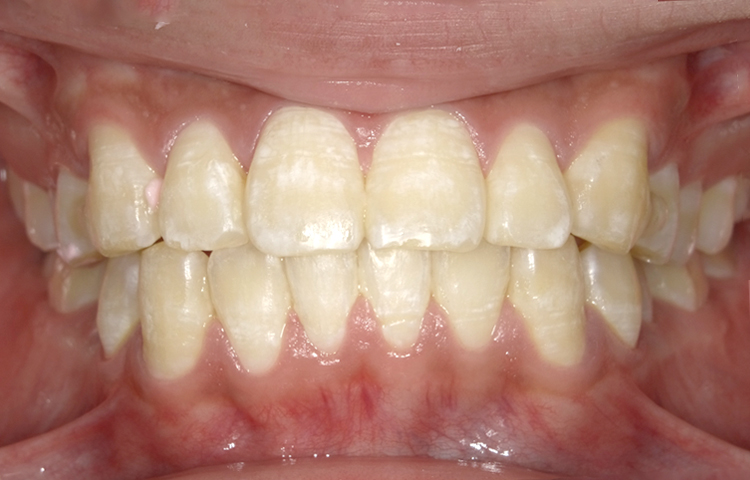 部分矯正の症例写真