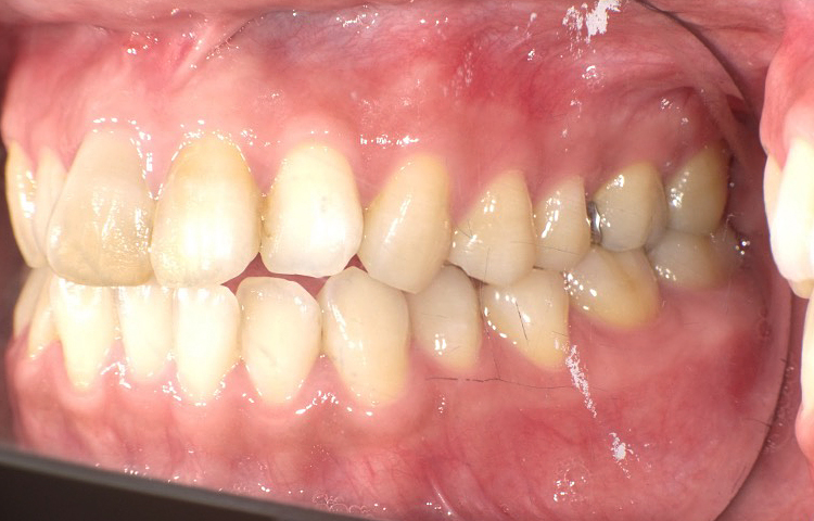 部分矯正の症例